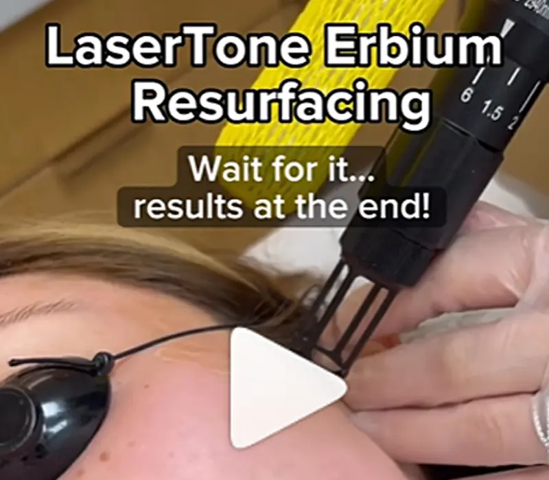 laser resurfacing AIREM