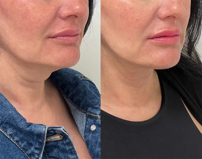 neck tightening results AIREM
