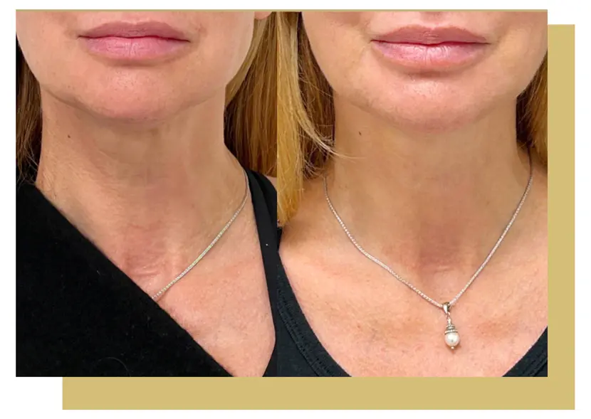 Plasmatite Dermasmooth