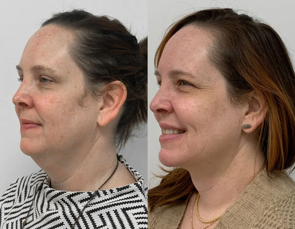 Plasmatite Neck Before After