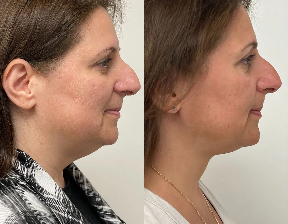 Plasmatite Neck Before After