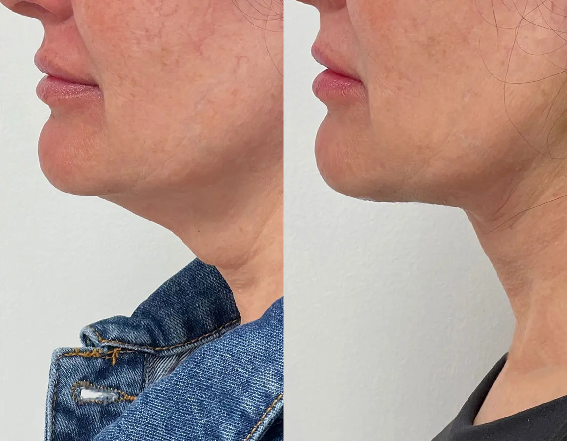 Plasmatite Neck Before After