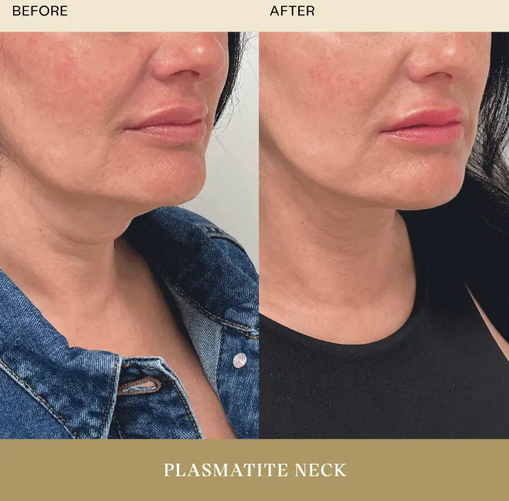 Plasmatite Neck Before After