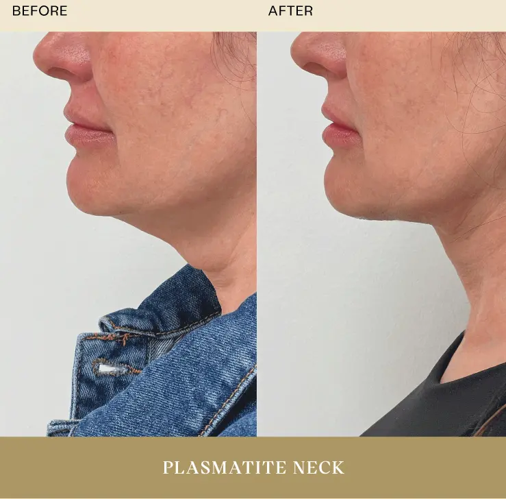 Plasmatite Neck Before After