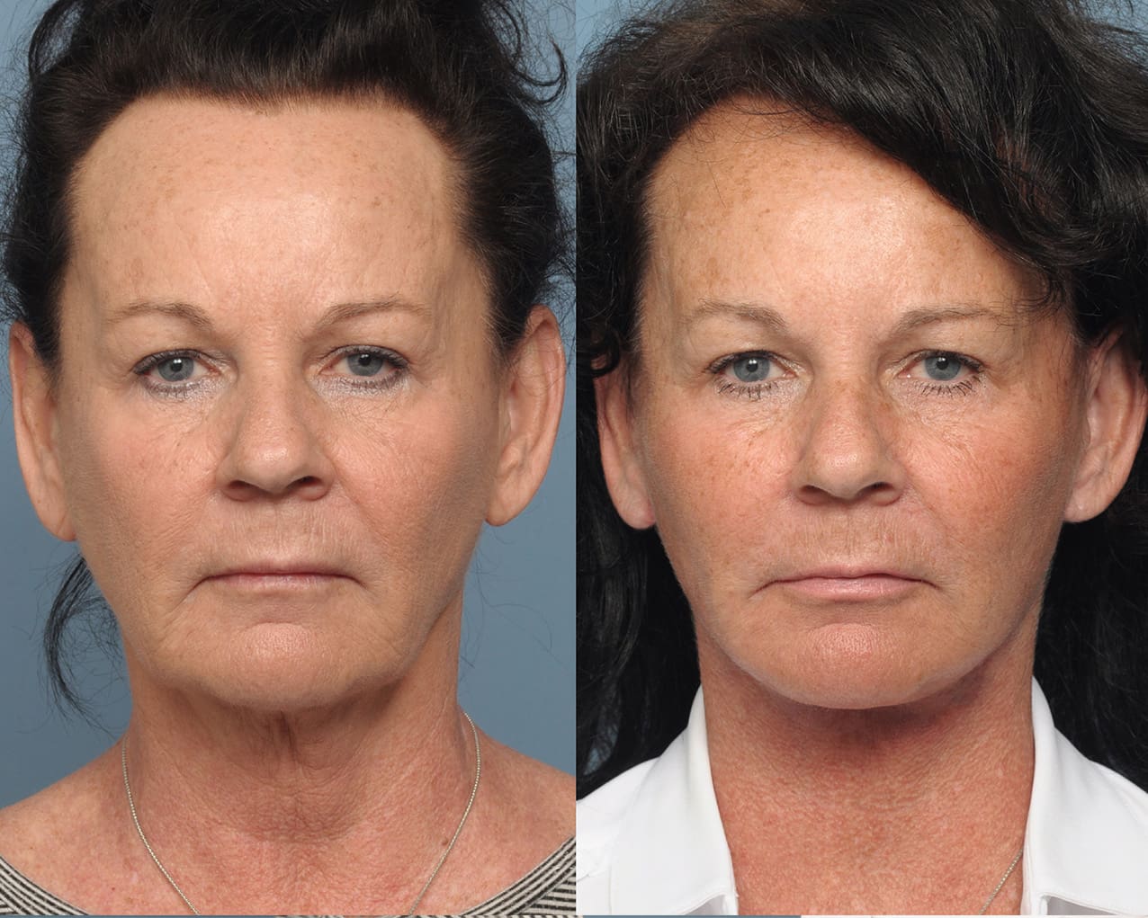 FACELIFT & NECK LIFT SURGERY: WHAT IT IS AND WHAT TO EXPECT