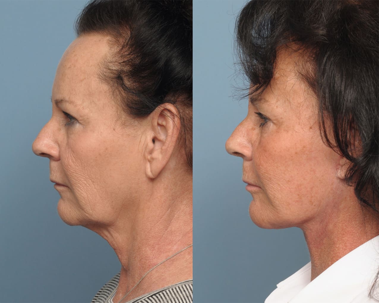 FACELIFT & NECK LIFT SURGERY: WHAT IT IS AND WHAT TO EXPECT
