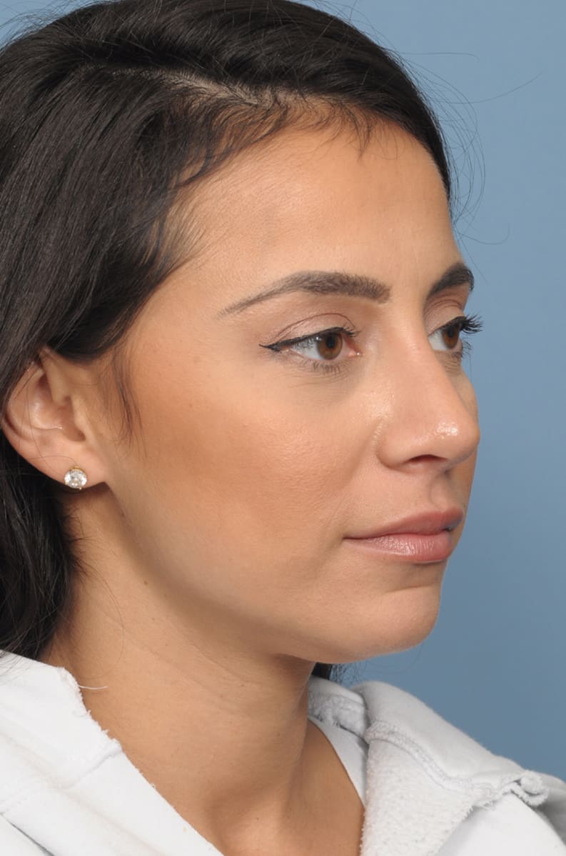 Rhinoplasty Long Island, NY | Queens Rhinoplasty