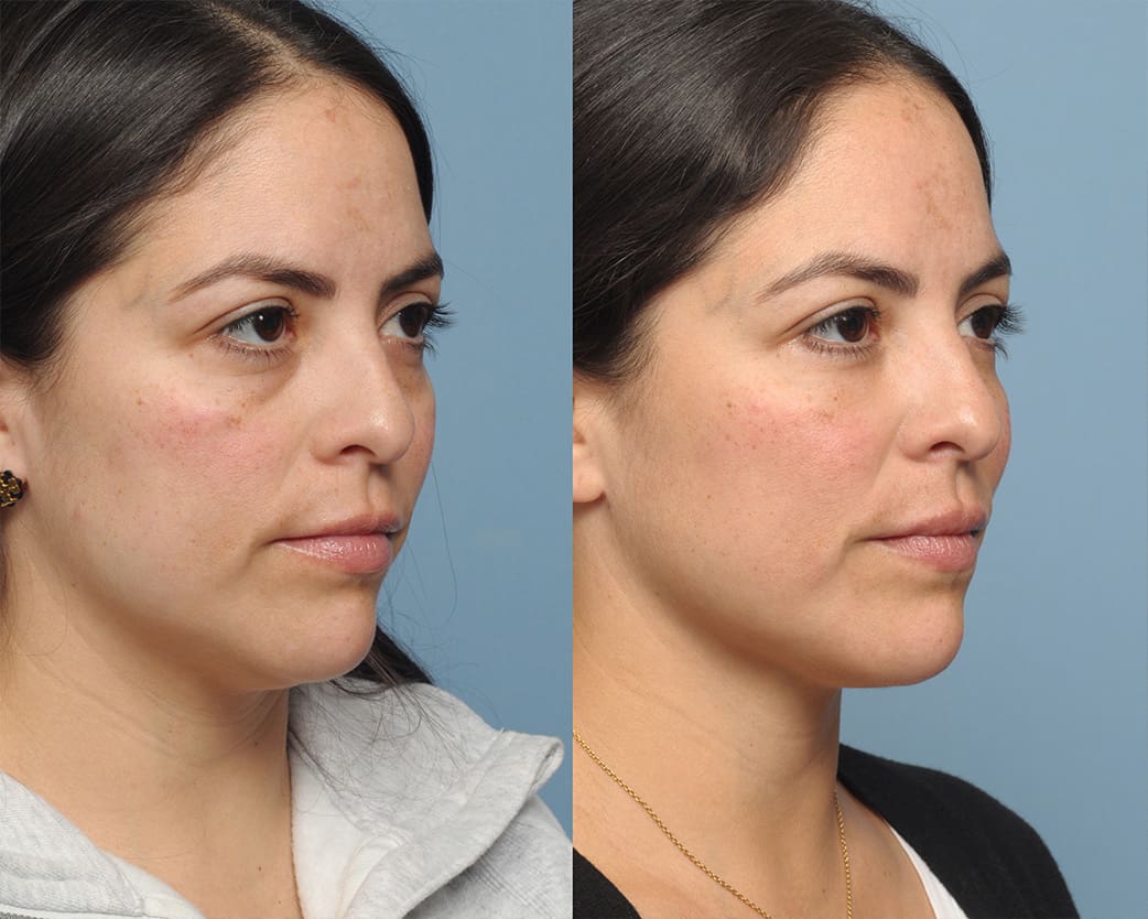 FACIAL LIPOSUCTION