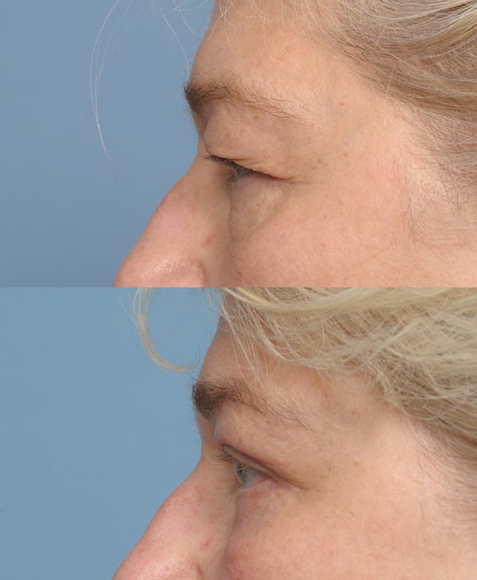 BLEPHAROPLASTY - Airem