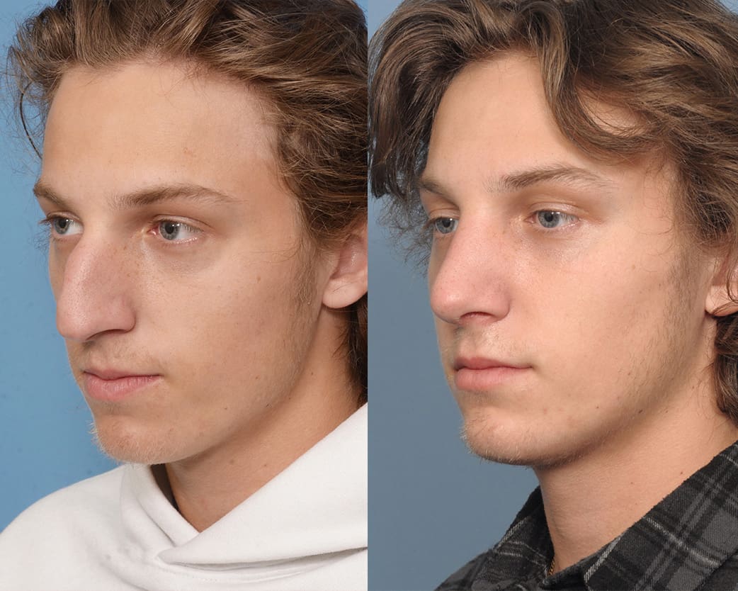 Rhinoplasty Long Island, NY | Queens Rhinoplasty