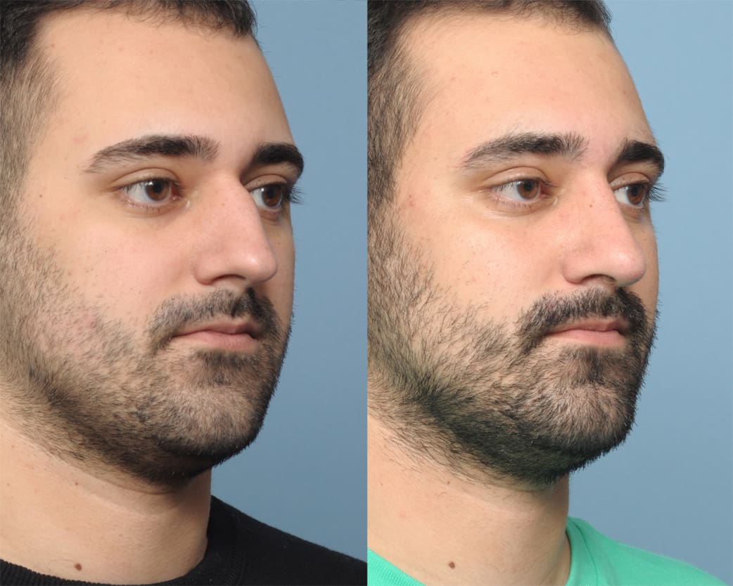 Rhinoplasty Long Island, NY | Queens Rhinoplasty