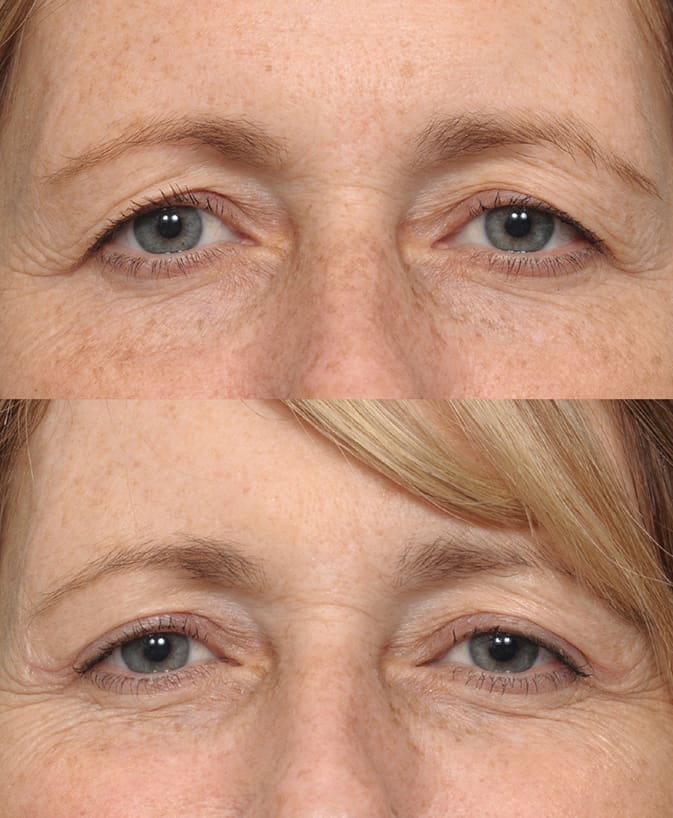 BLEPHAROPLASTY - Airem