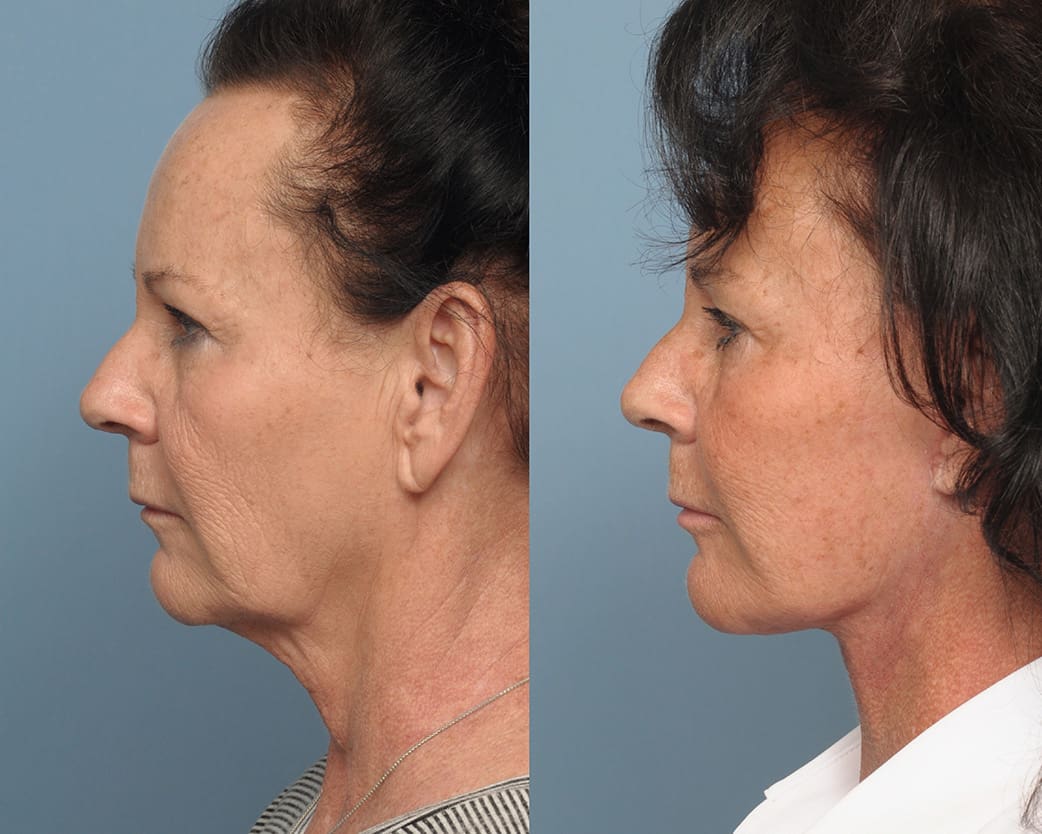 Neck Lift Long Island, NY | Queens Neck Lift