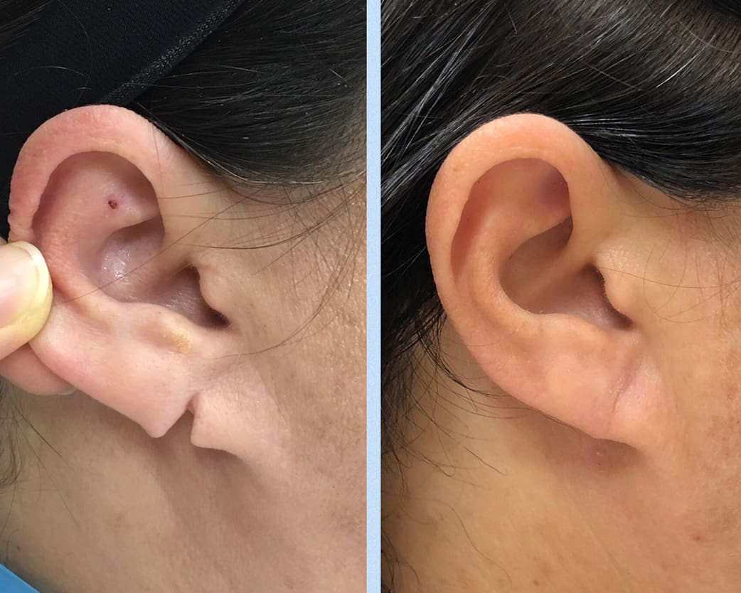 Earlobe Repair Long Island, NY | Queens Otoplasty