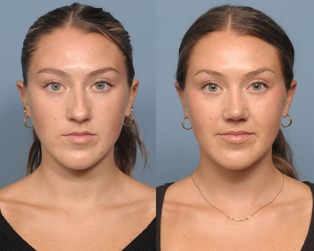 Rhinoplasty Long Island, NY | Queens Rhinoplasty