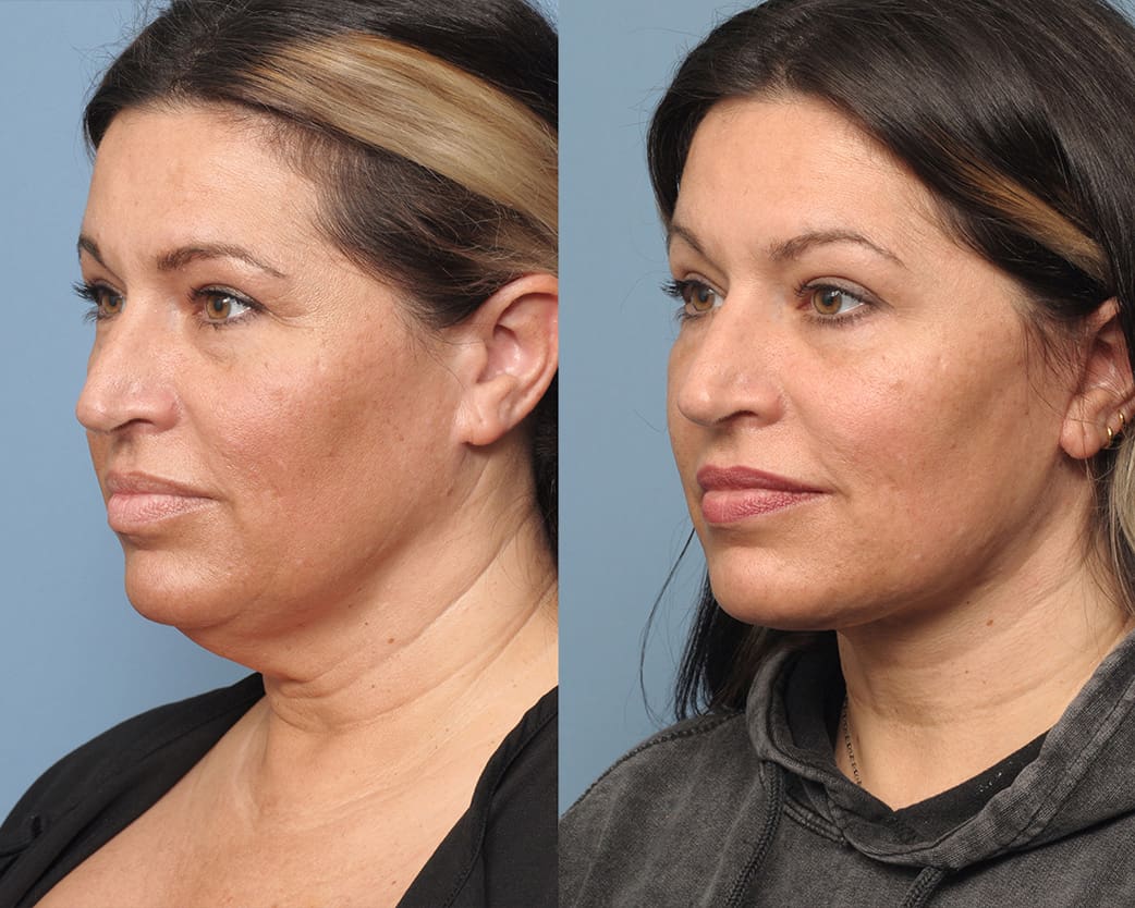 Neck Lift Long Island, NY | Queens Neck Lift