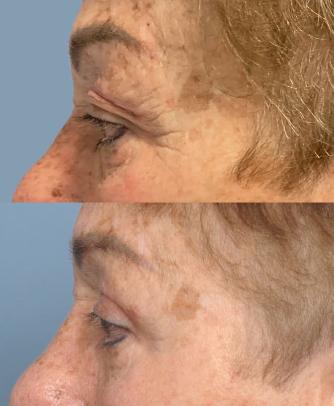 BLEPHAROPLASTY - Airem