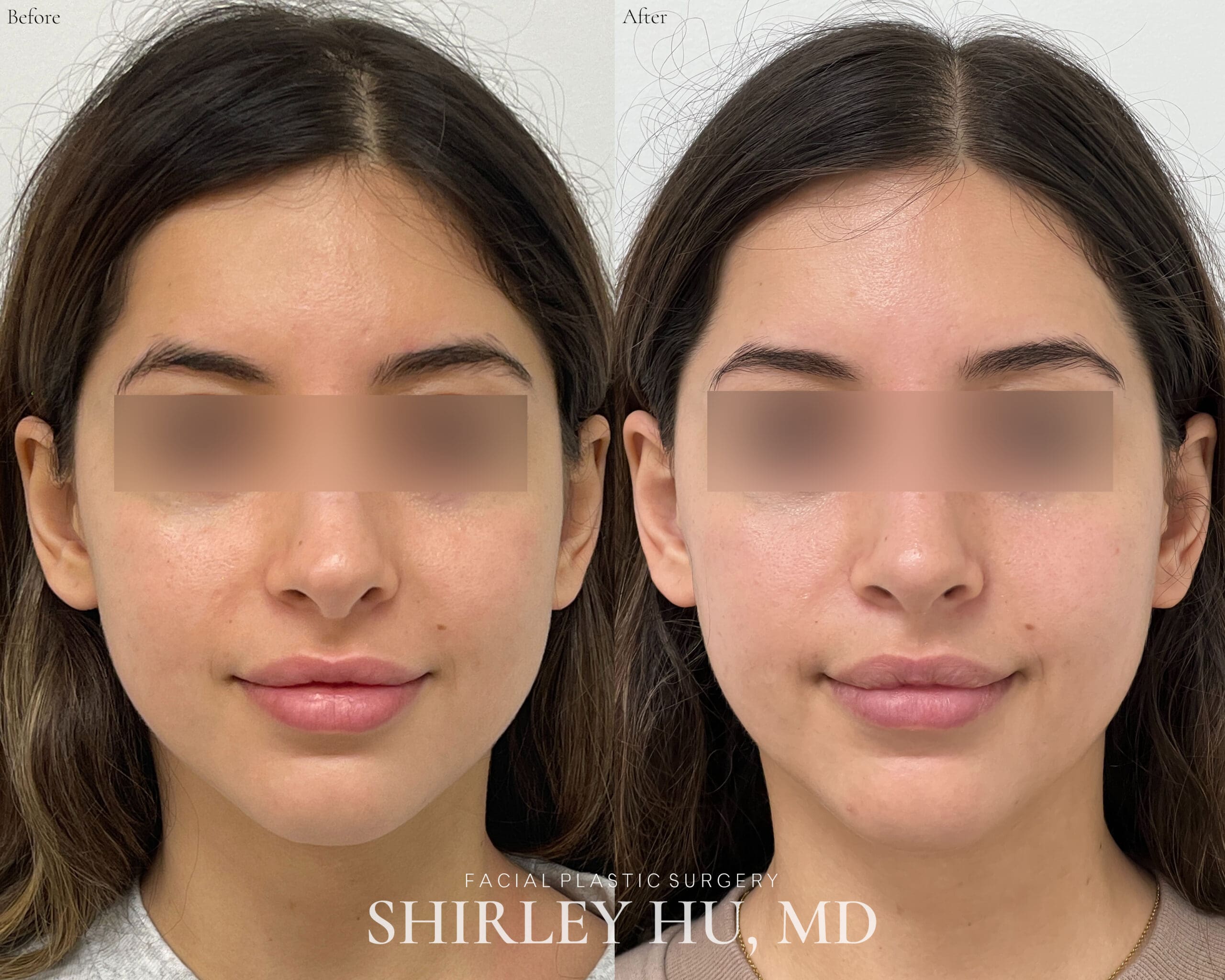 New York's Top Rhinoplasty Surgeon