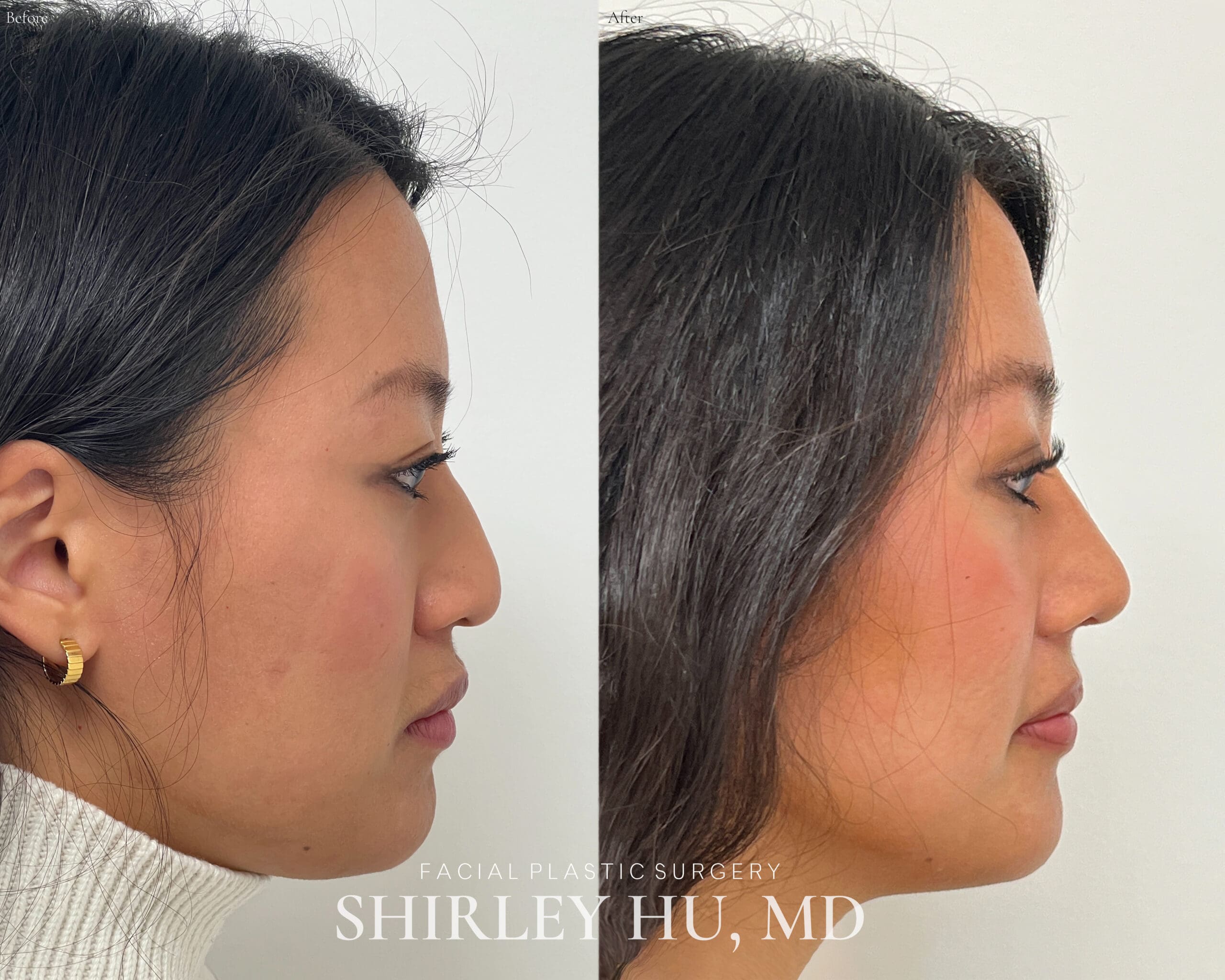 New York's Top Rhinoplasty Surgeon