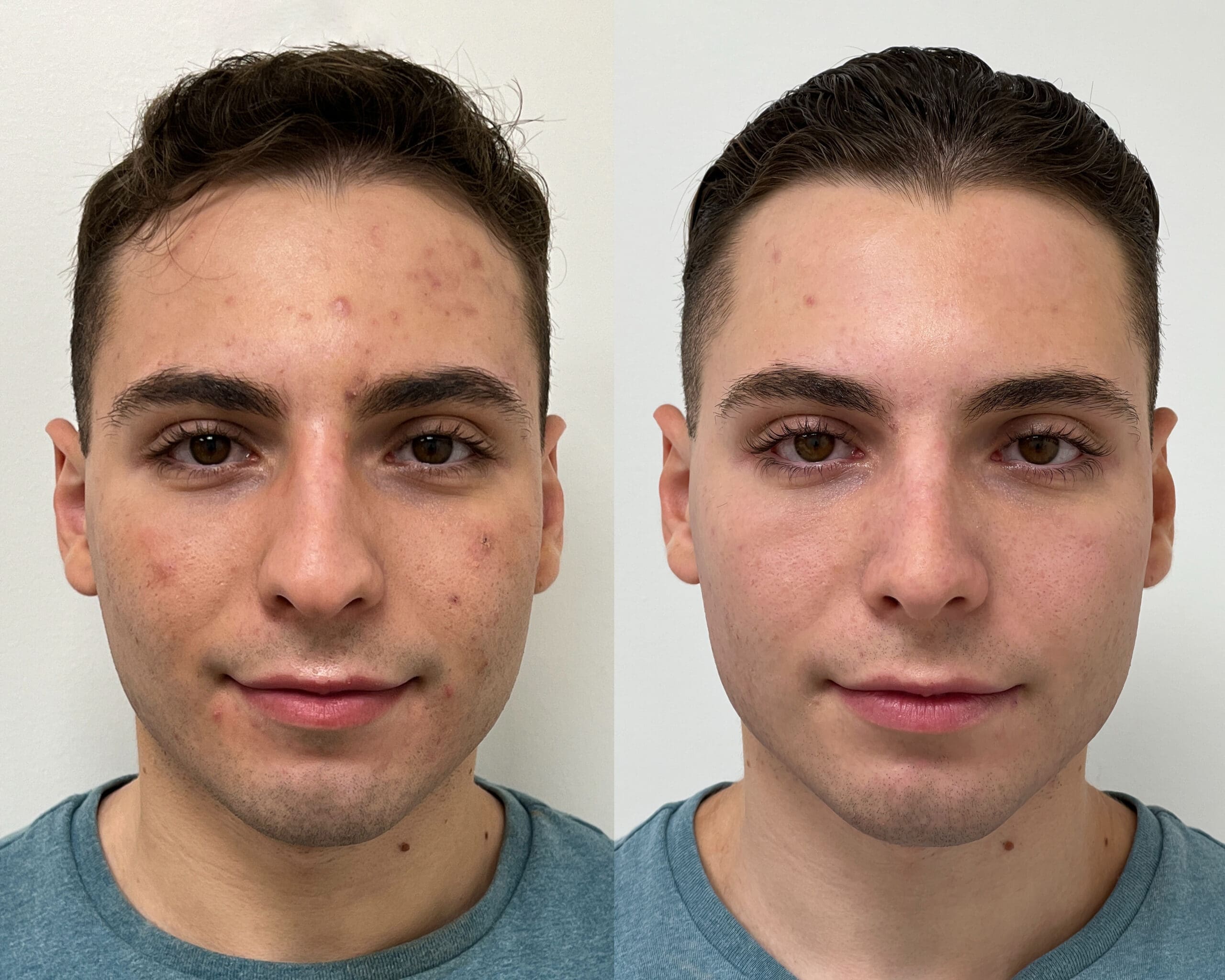 New York's Top Rhinoplasty Surgeon