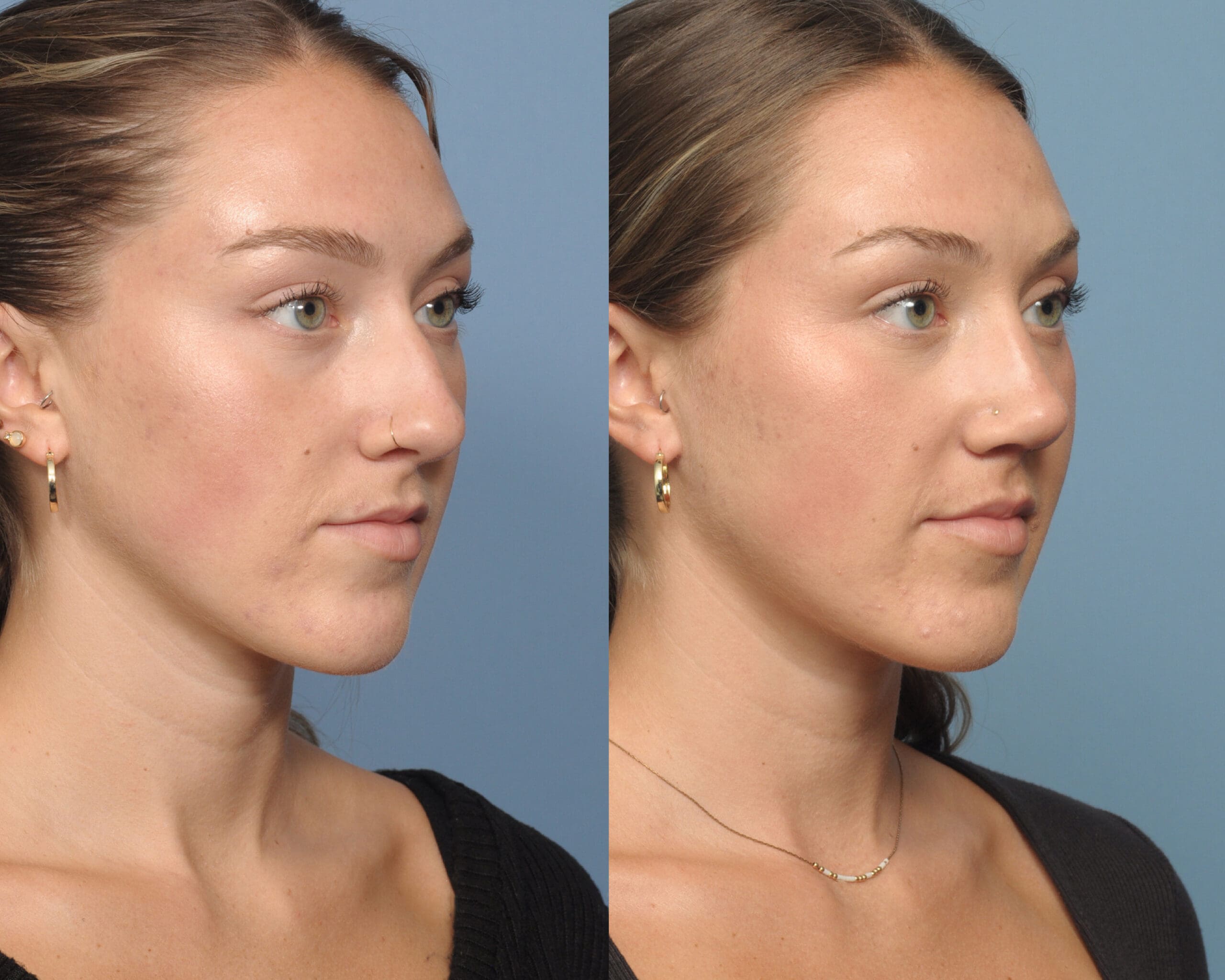 New York's Top Rhinoplasty Surgeon