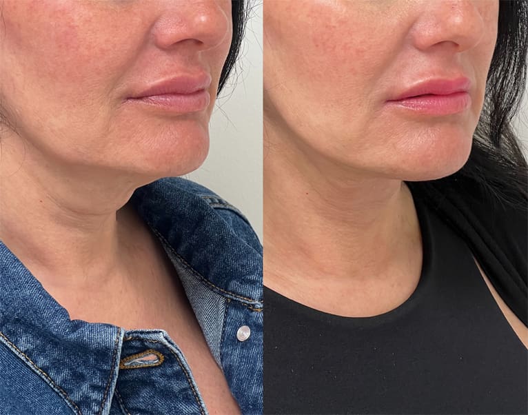 Plasma Tite Neck Before & After