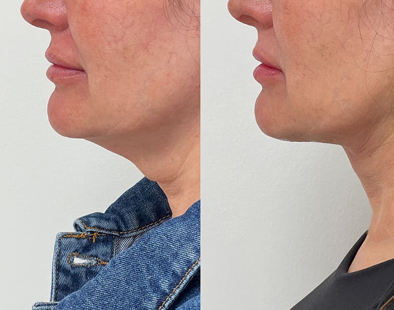 Plasma Tite Neck Before & After